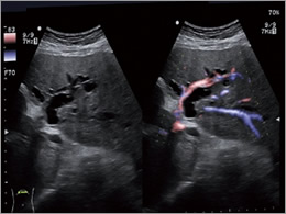腹部超音波（エコー）検査 写真